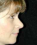 Nose Surgery