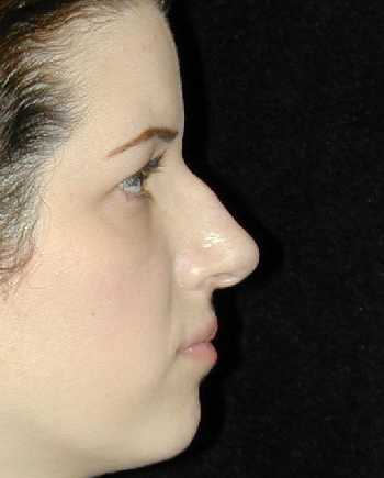 Nose Surgery