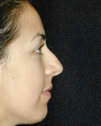 Nose Surgery