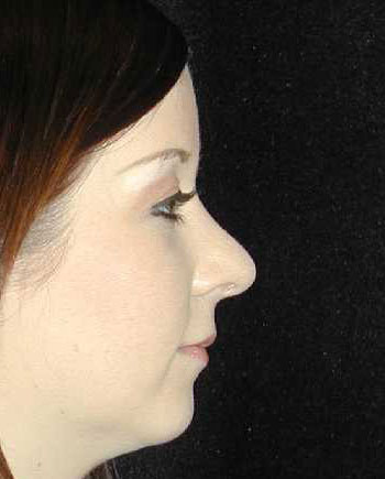 Nose Surgery