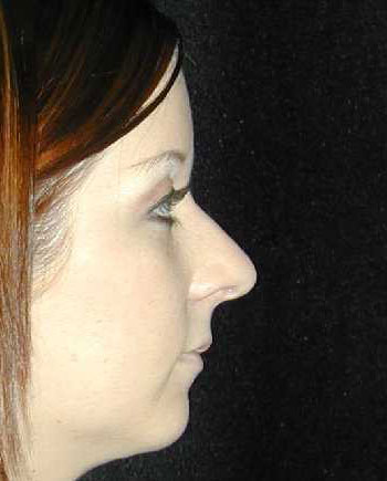 Nose Surgery