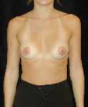 Breast Implant