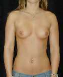 Breast Implant