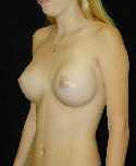 Breast Implant