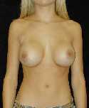 Breast Implant