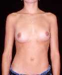 Breast Implant