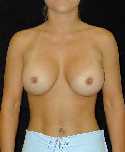 Breast Implant