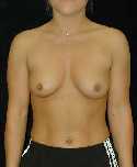 Breast Implant