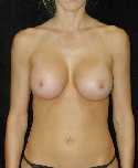 Breast Implant