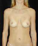 Breast Implant