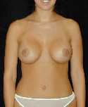 Breast Implant