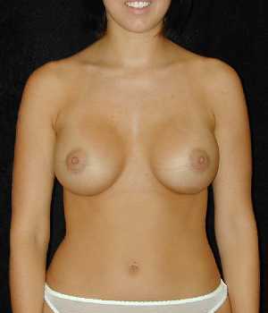 Breast Augmentation Surgery