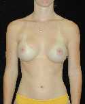 Breast Implant