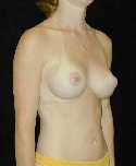 Breast Implant