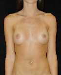 Breast Implant