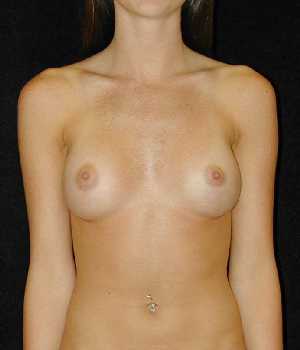 Breast Augmentation Surgery