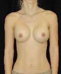 Breast Implant