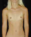 Breast Implant