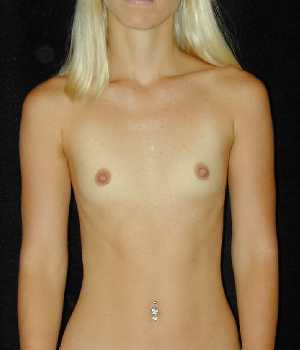 Breast Augmentation Surgery