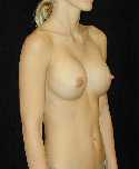 Breast Implant