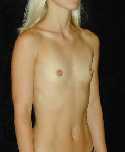 Breast Implant