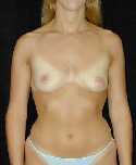 Breast Implant