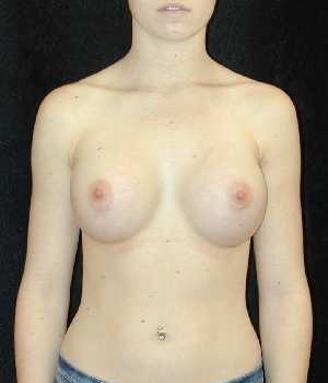 Breast Augmentation Surgery