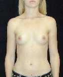 Breast Implant