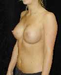 Breast Implant