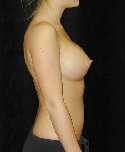 Breast Implant