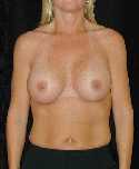 Breast Implant