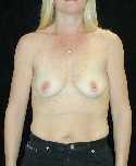 Breast Implant