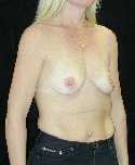 Breast Implant