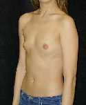 Breast Implant