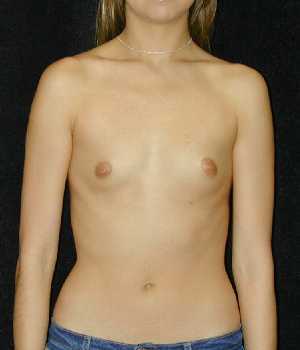 Breast Augmentation Surgery