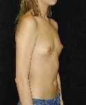 Breast Implant