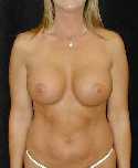 Breast Implant