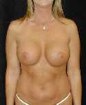 Breast Implant