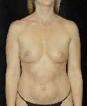 Breast Implant