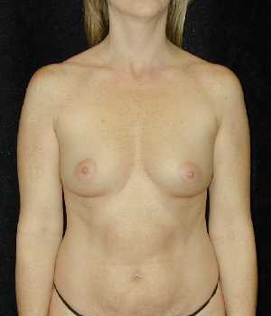 Breast Augmentation Surgery