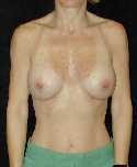 Breast Implant