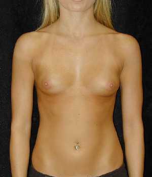 Breast Augmentation Surgery