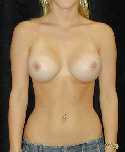 Breast Implant