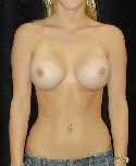 Breast Implant