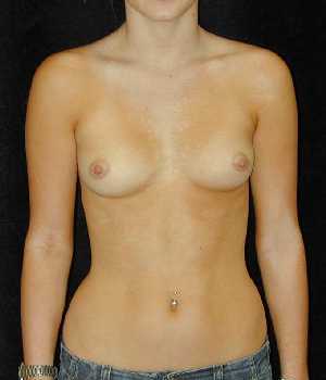 Breast Augmentation Surgery