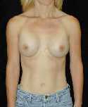 Breast Implant