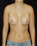 Breast Implant