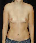 Breast Implant