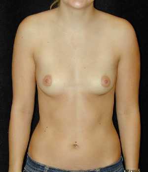 Breast Augmentation Surgery