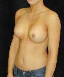 Breast Implant